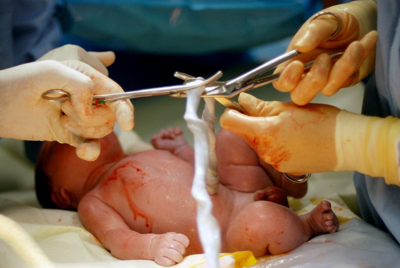 Obstetricians cutting the umbilical cord of a newborn baby boy after an caesarean section birth at a modern hospital. Baby is lying on mother's thigh.