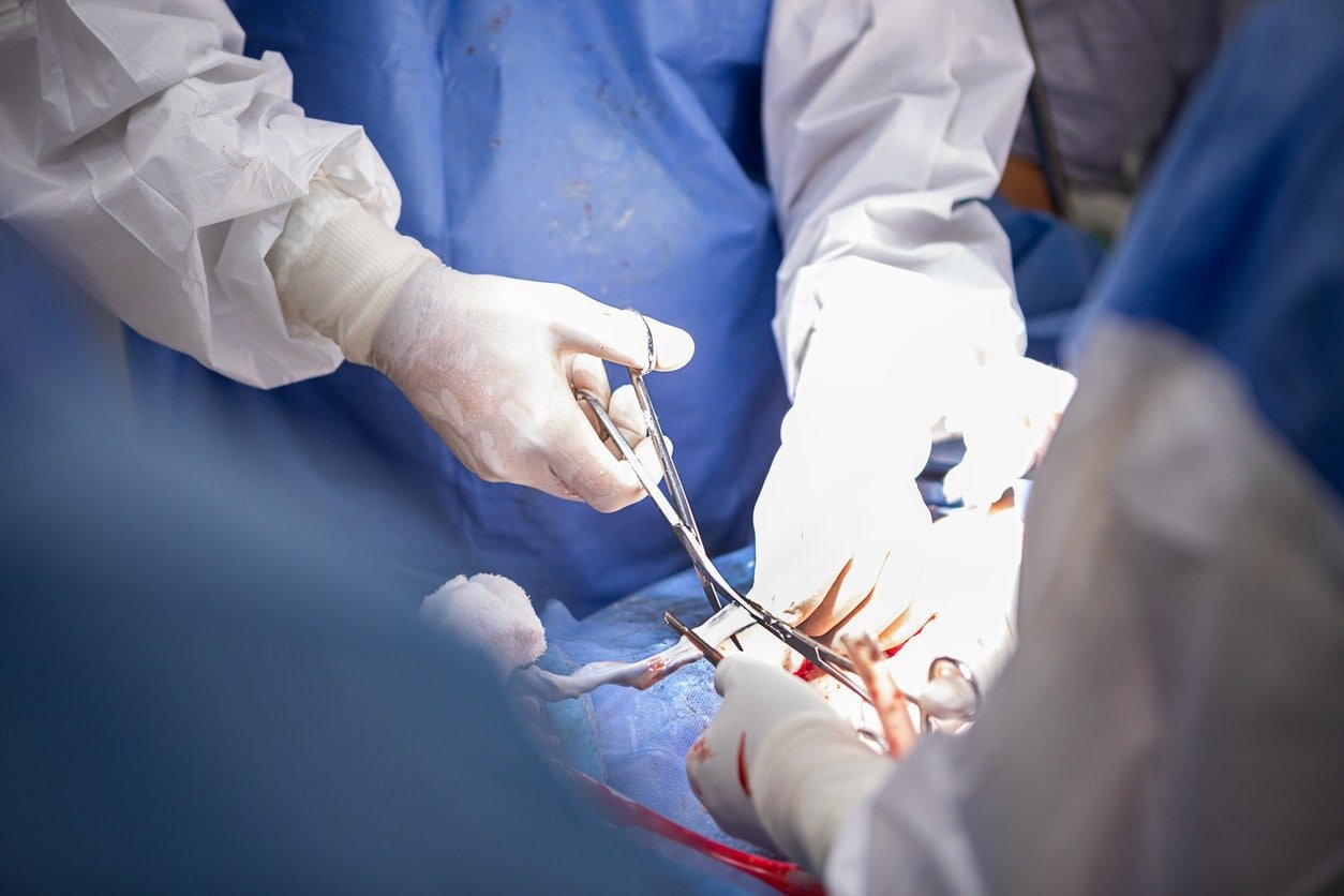 Doctors performing a cesarean section in the operating room