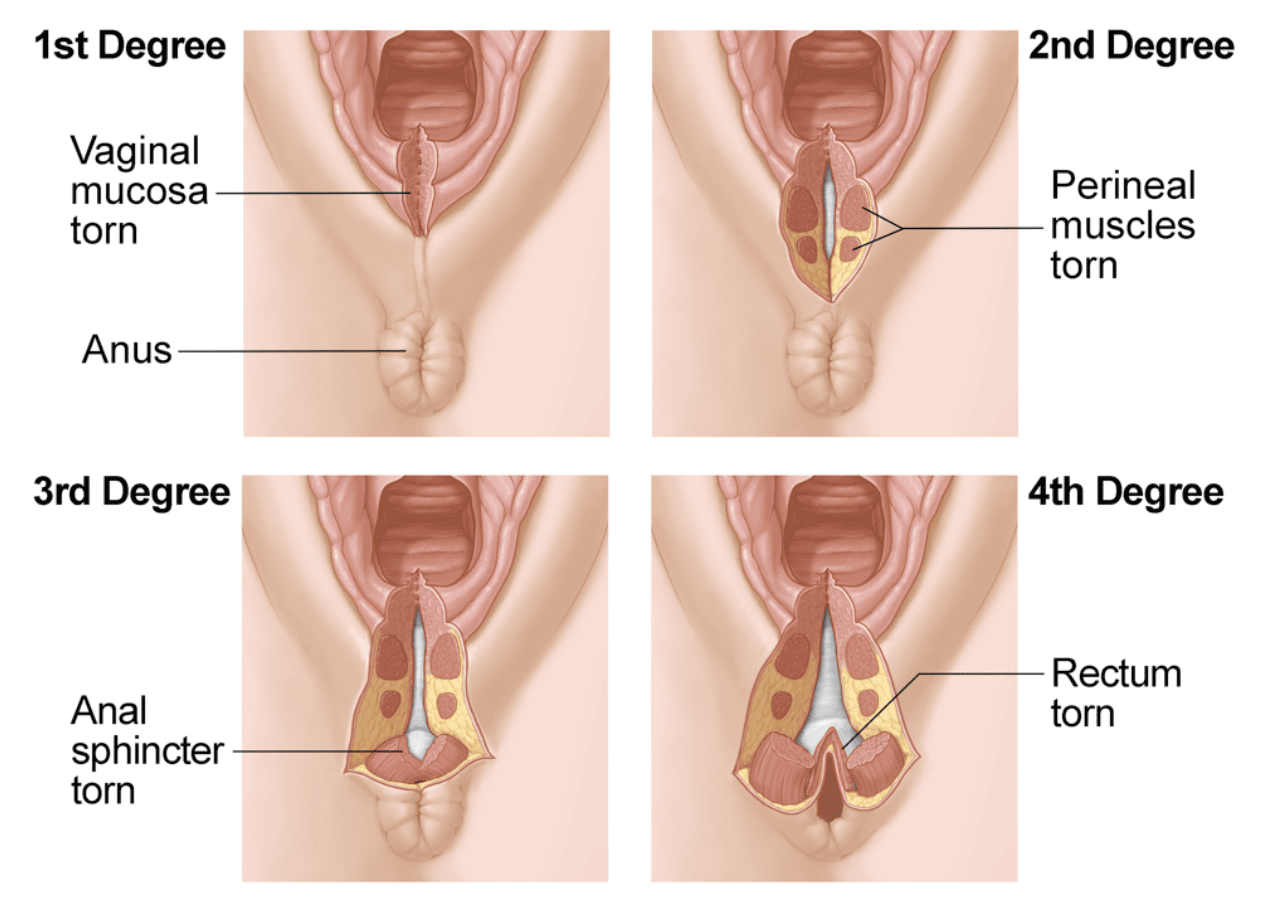 Graphic of the different degress of perineal tearing during childbirth