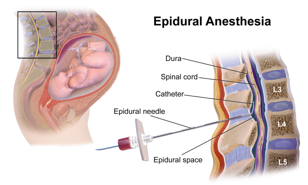epidural anesthesia chart