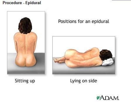 epidural positions