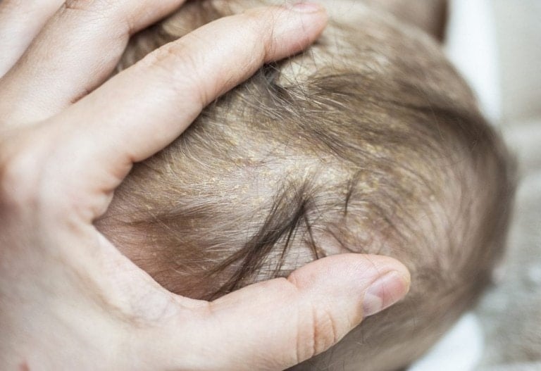 close up shot of a baby's head showing symptoms of cradle crap