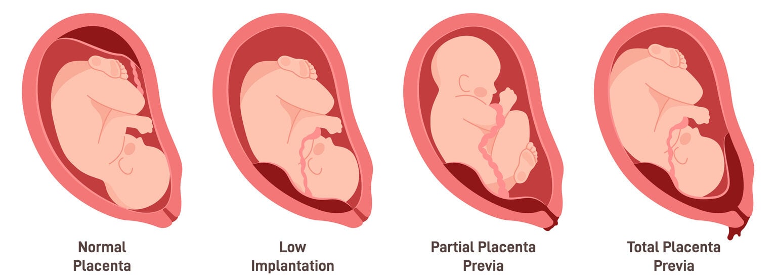 Different placental locations during pregnancy. Placenta previa, total, low and partial. Pregnancy pathology set.