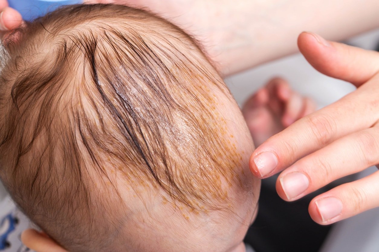 Smearing a seborrheic crust with baby oil on a child's head. Combing and removal of seborrheic crust.