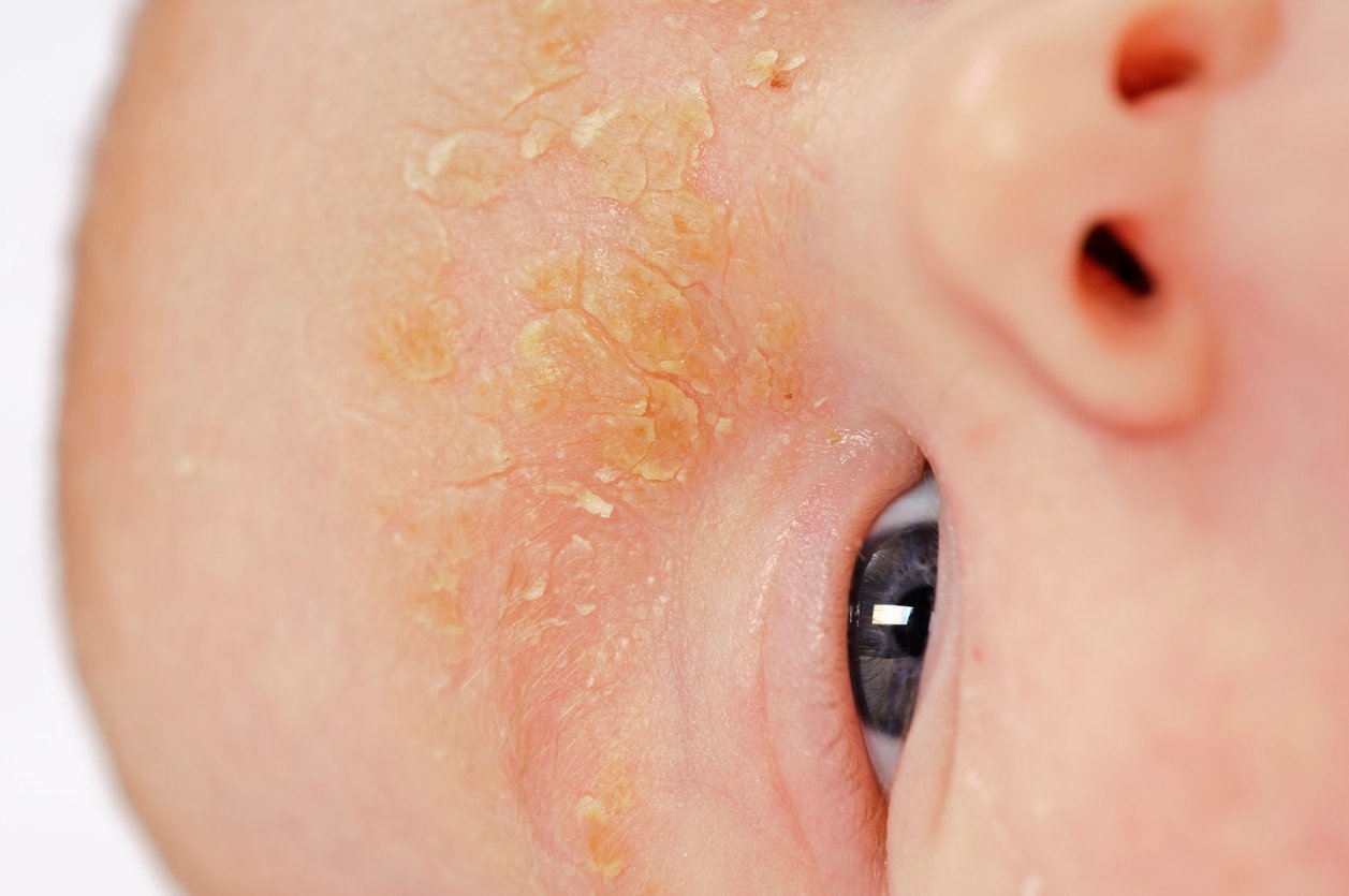 Baby with seborrheic dermatitis on face.