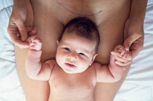 A newborn baby lies on their back, holding an adults hands. A healing surgical scar is visible on the adults lower abdomen.