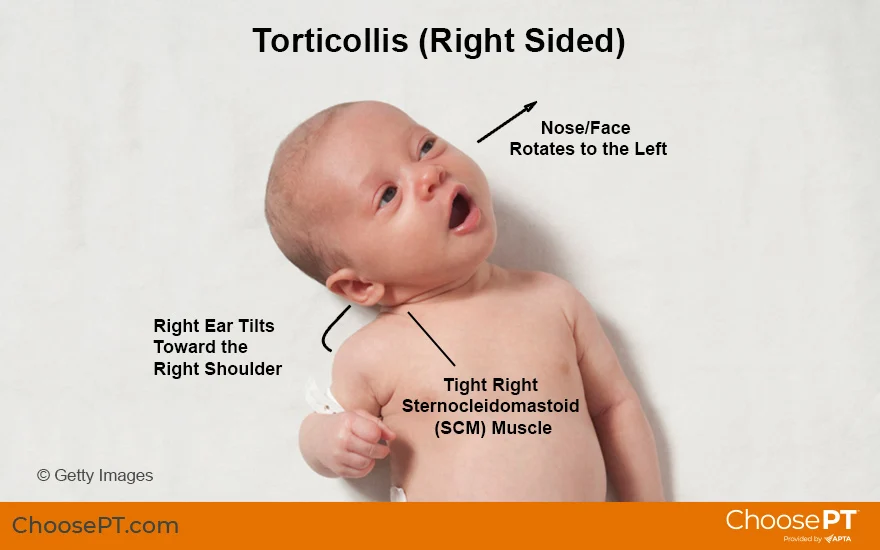 Baby with torticollis