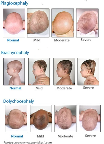 diagram of different levels of flat heads on baby