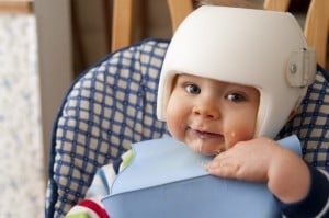 Baby boy with plagiocephaly wearing a helmet.