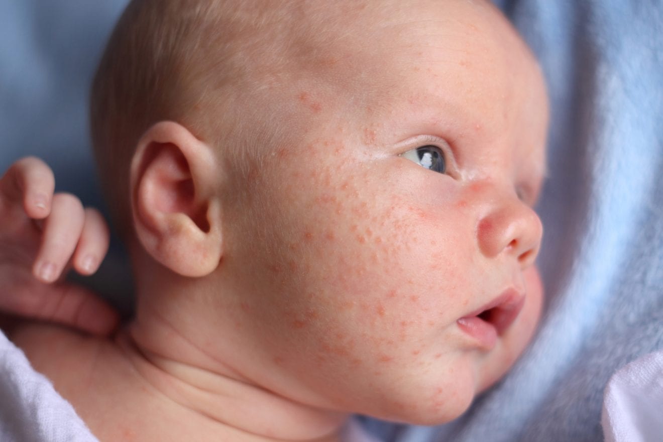Newborn baby with a case of baby acne