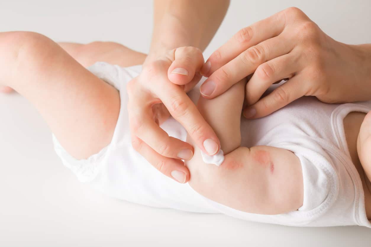 A mother gently applies heat rash cream to a baby's arm, soothing the red marks that indicate classic heat rash symptoms. The baby, in a white outfit, lies calmly as the focus remains on the tender application of this effective heat rash treatment.