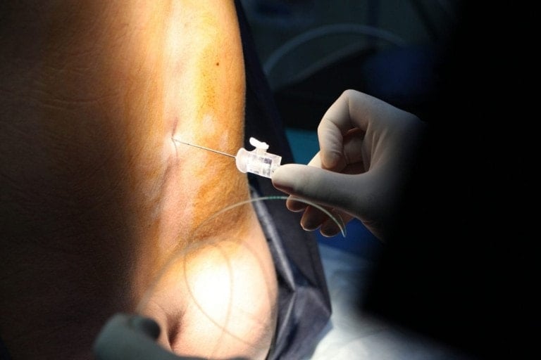 Close-up of a medical procedure. A hand wearing a white glove holds a needle inserted into the skin of a patient's back. The procedure, which some might wish they had known before getting an epidural, appears to be taking place in a clinical setting with focused lighting on the insertion area.