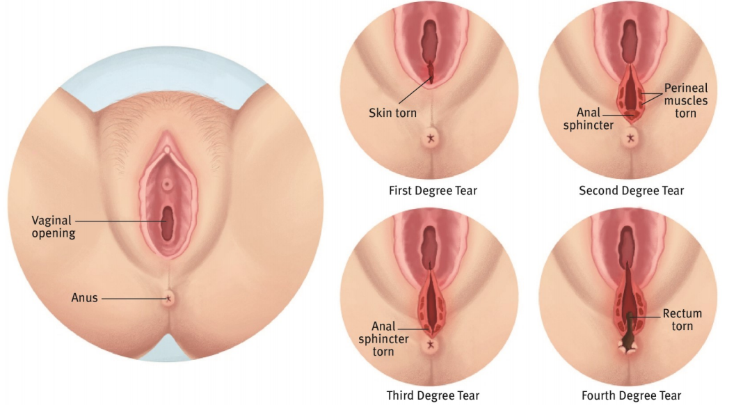 Different degrees of perineal tears