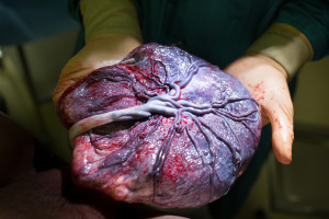 A gloved medical professional delicately holds the placenta, dark red and maroon with visible blood vessels, seamlessly connected to an umbilical cord. The professional's hands and the placenta are the main focus in this striking image.