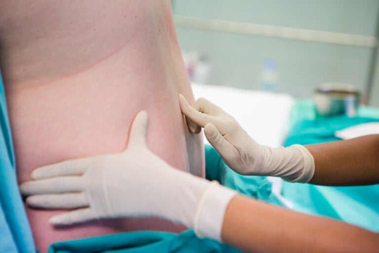 Close up image of a doctor doing a spinal block epidural on a pregnant woman just before child birth is to take place.