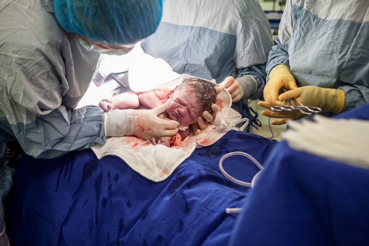 baby born via Caesarean Section