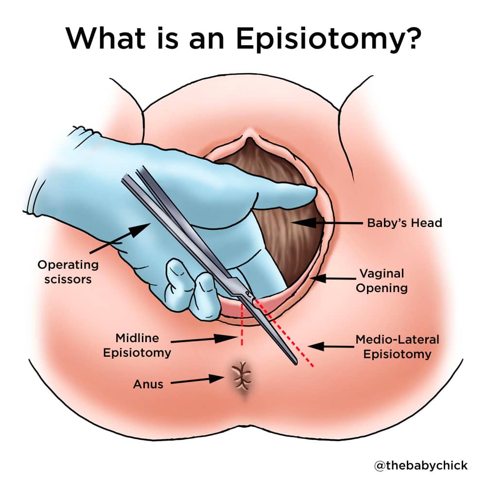 Illustration of an episiotomy