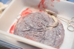 A placenta shortly after the cord was cut from the baby.