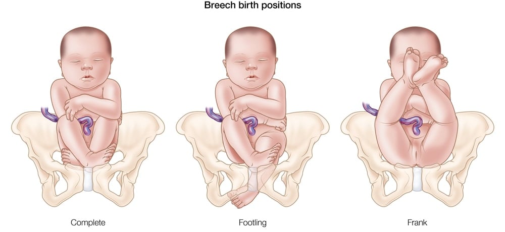 Breech Birth Positions of Baby