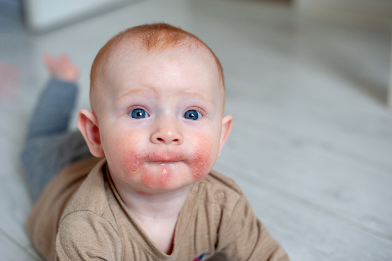 Traces of diathesis, allergies on baby's cheeks