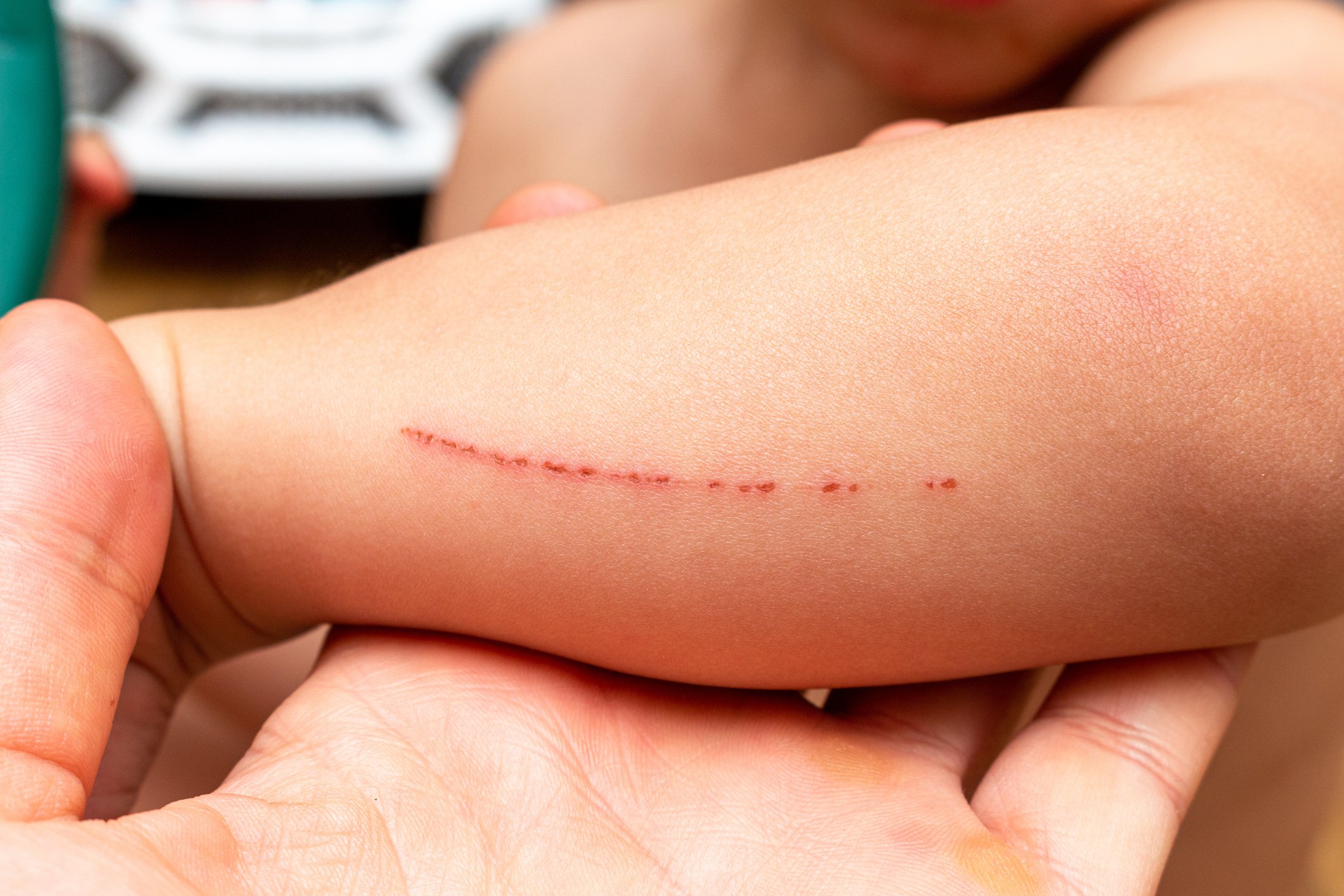 wounds, scratches, abrasions on the child's hand, wrist, forearm close up