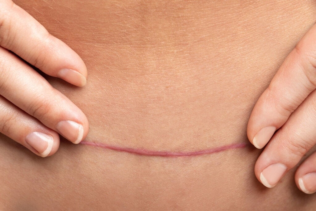 Closeup of scar after C-Section surgery on female belly