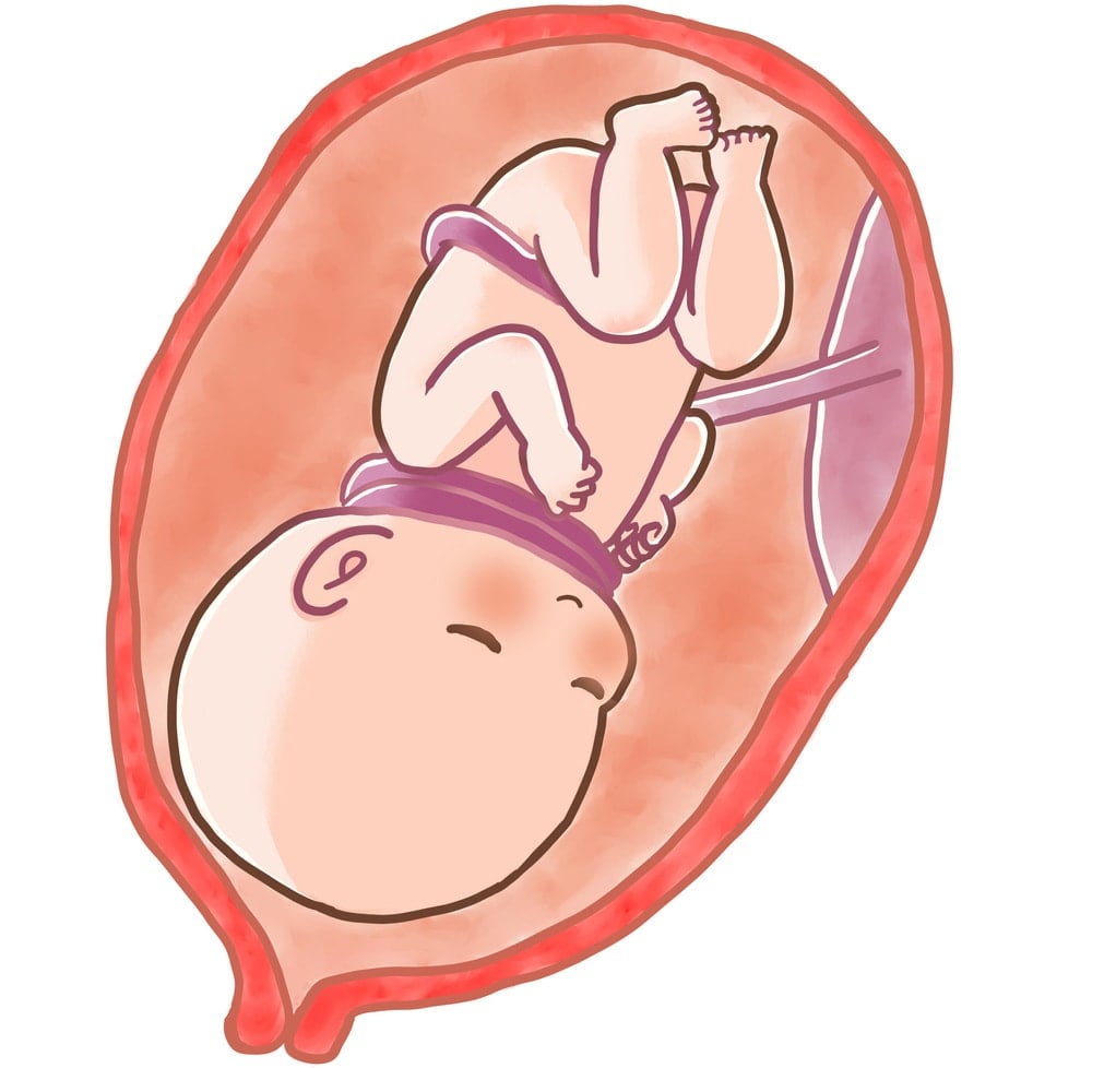 बच्चे के गले में गर्भनाल फंसने के कारण और लक्षण