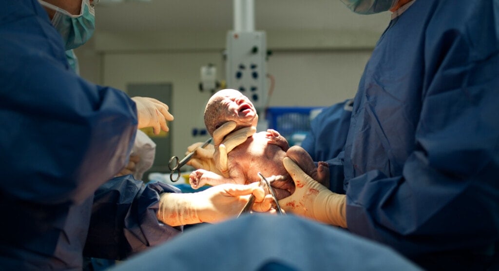 Baby being born via Cesarean Section coming out