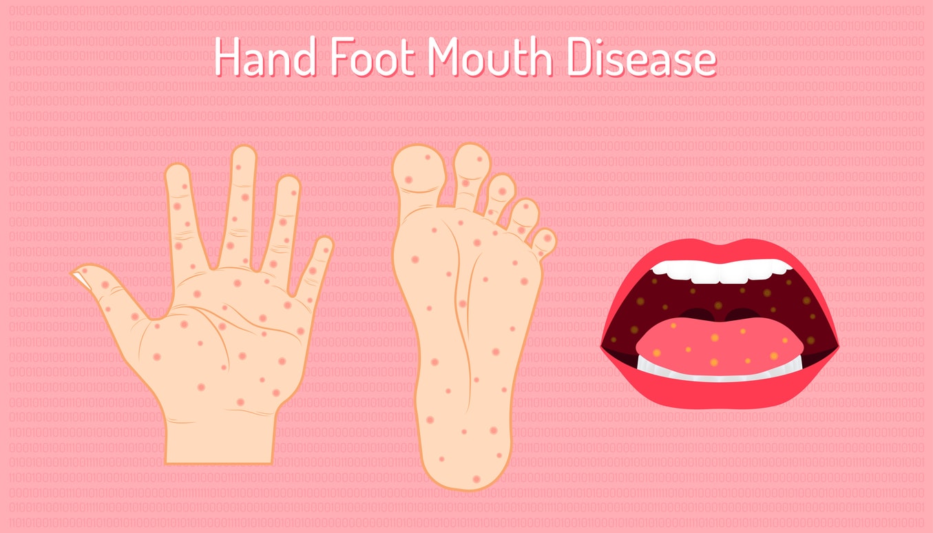 hand foot mouth disease. enteroviruses or EV71 is name of virus. be careful of your children and yourself.