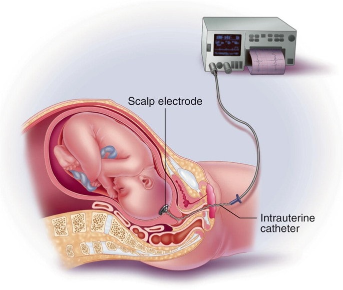 Internal monitoring during labor. This is a drawing of it.