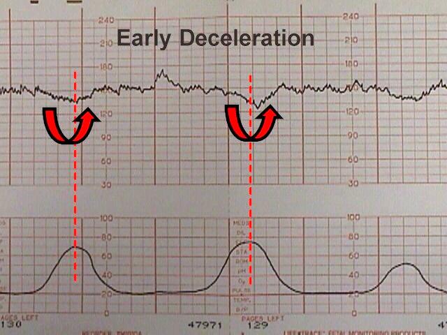 A look at early decelerations on a strip of contractions and baby's heart rate.