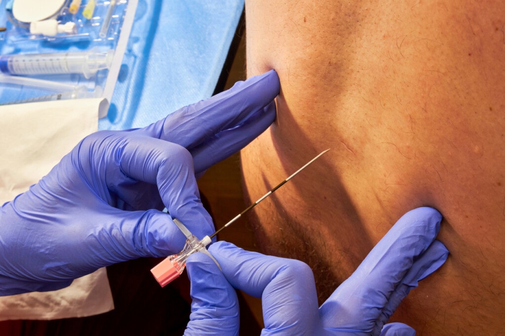 Anesthesiologist installing an epidural catheter for a patient