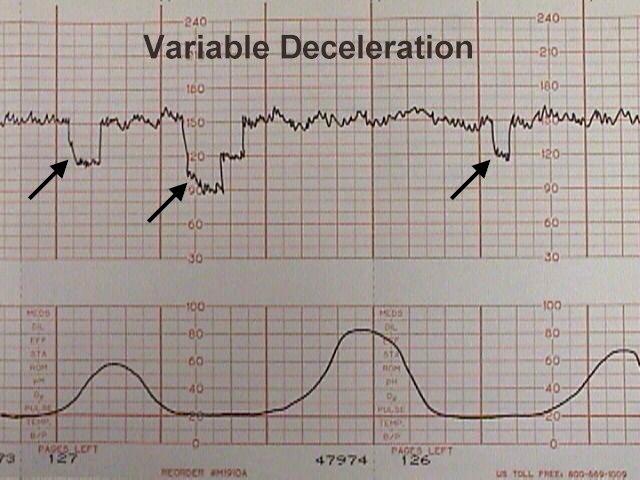 A look at variable decelerations on a strip of contractions and baby's heart rate.