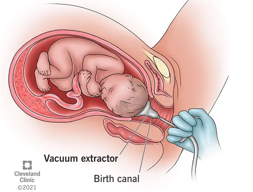 Drawn graphic demonstrating a vacuum birth