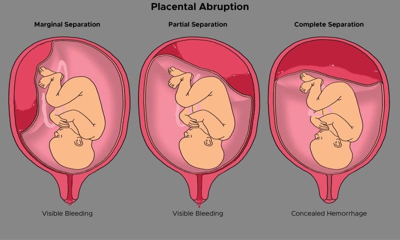 graphic demonstrating what placental abruption looks like