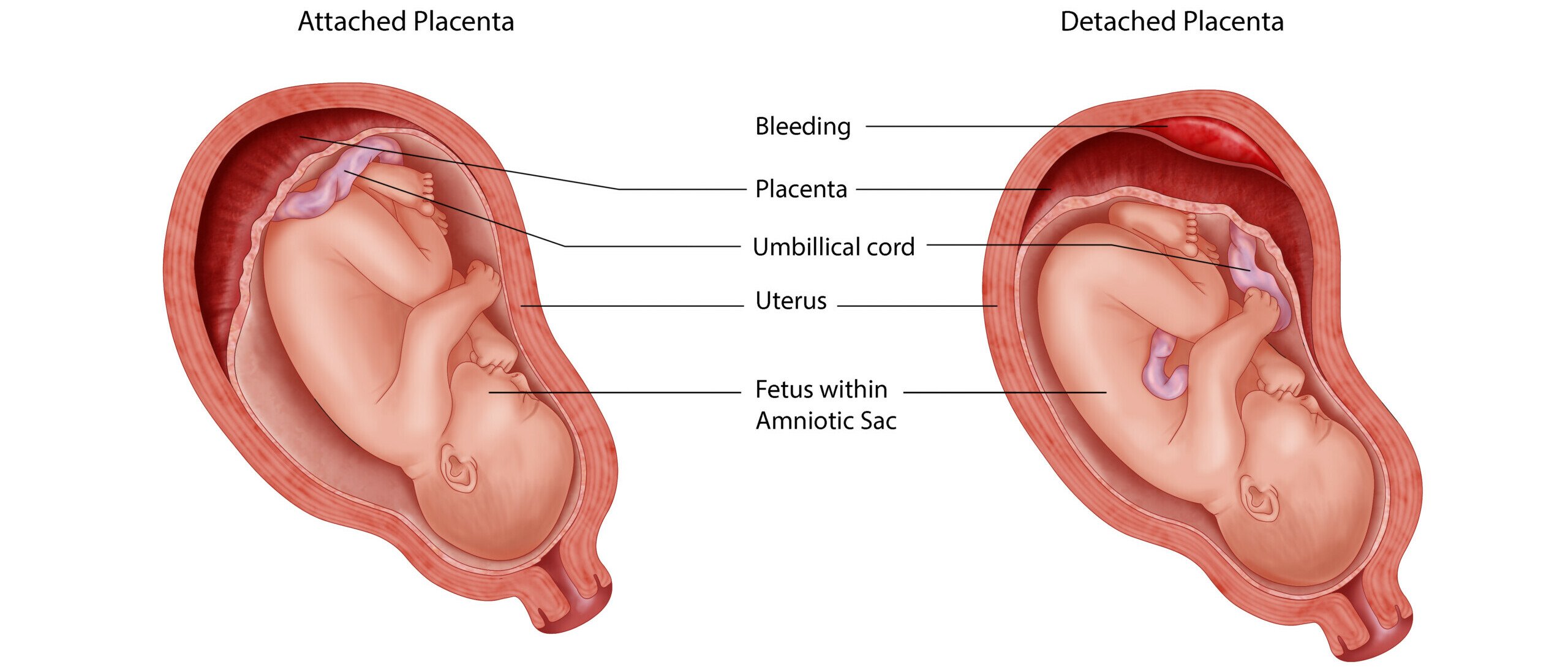 graphic demonstrating what placental abruption looks like