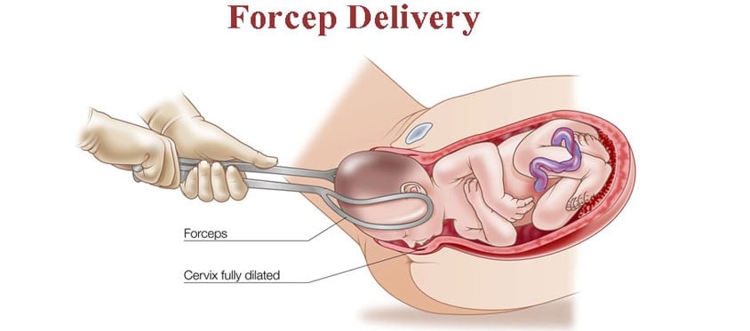 Forceps delivery illustration