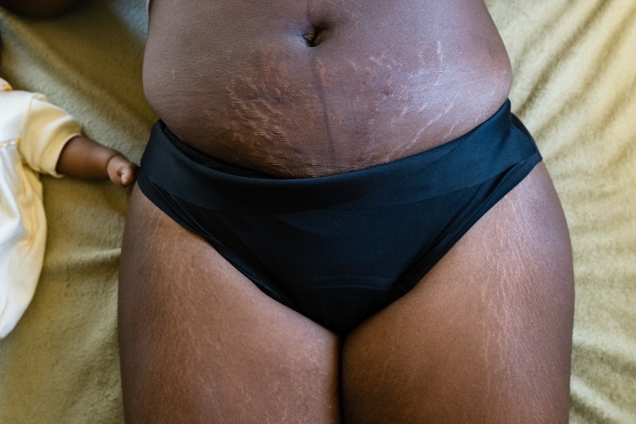 Postpartum stretch marks on the belly and linea nigra.