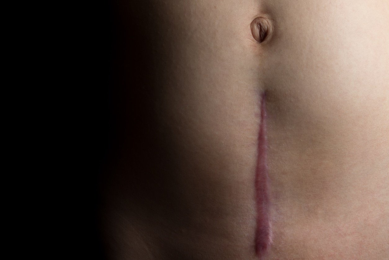 A recovering scar from a c-section operation dramatically faded to black.A recovering scar from a c-section operation.