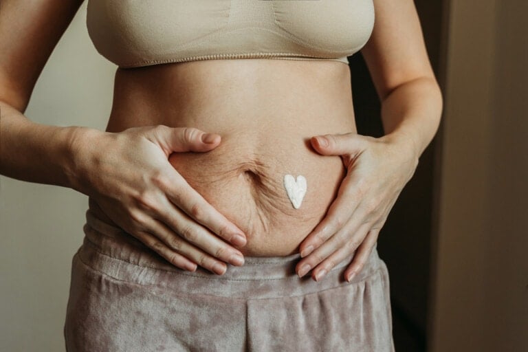 Young woman put cream on her belly full of stretch marks after pregnancy. Close up view.