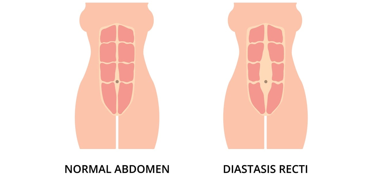 Normal toned abdomen muscles and diastasis recti, also known as abdominal separation, common among pregnant women